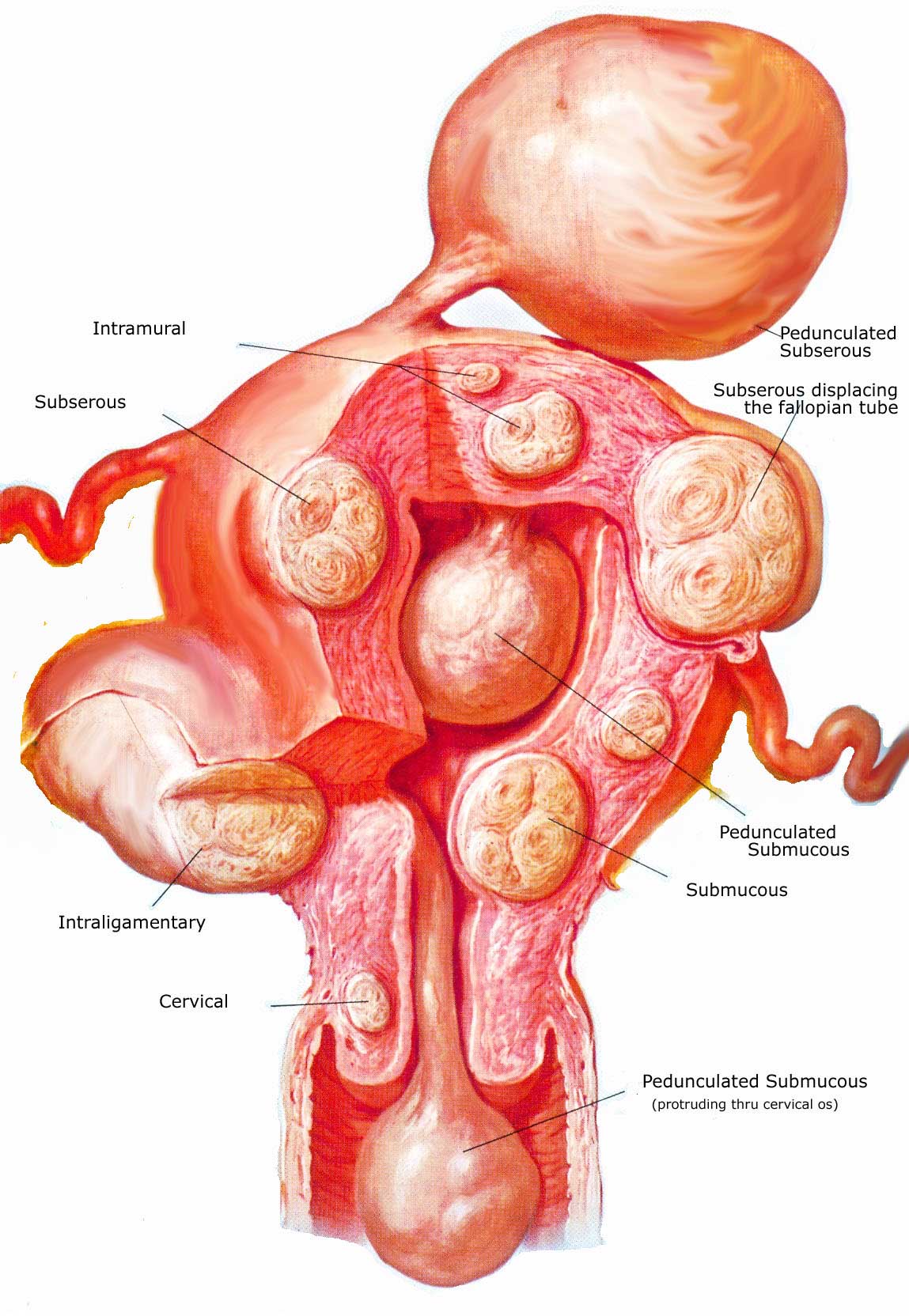 Fibroids