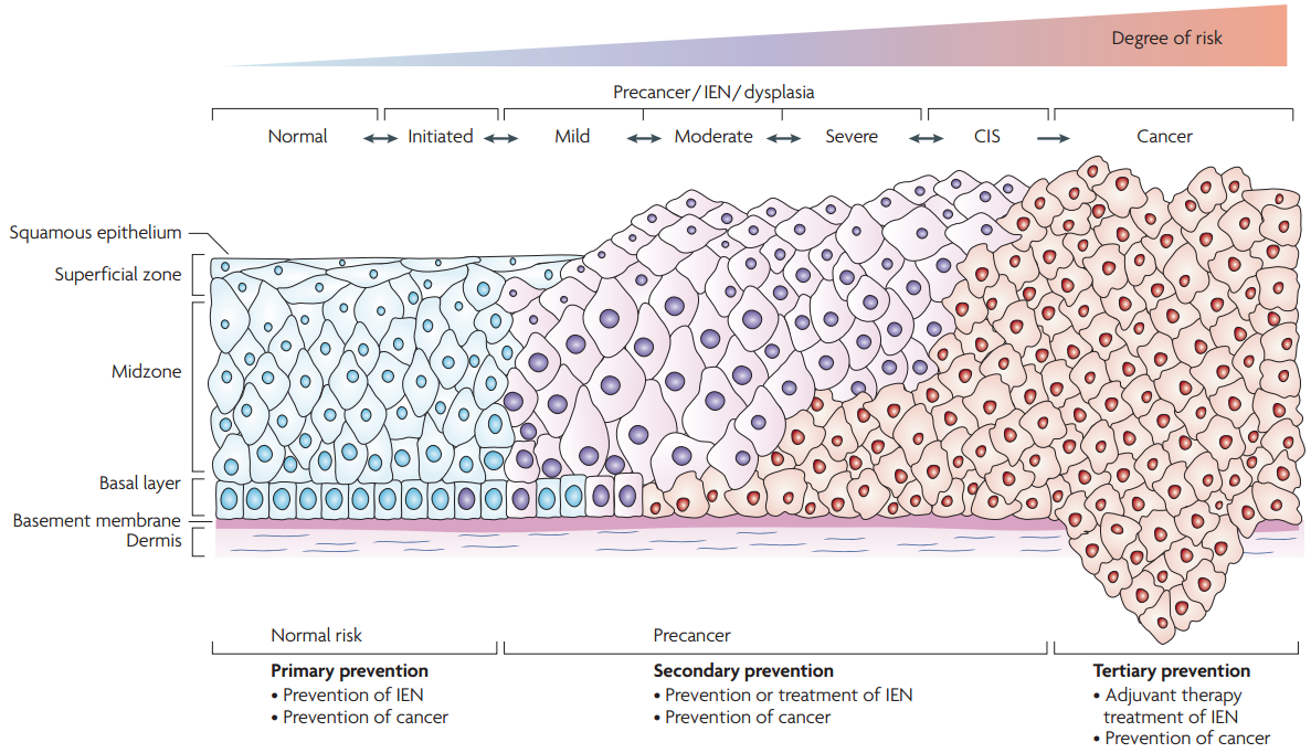 Pathology diagram of a Pap smear from normal to more severe dysplasia